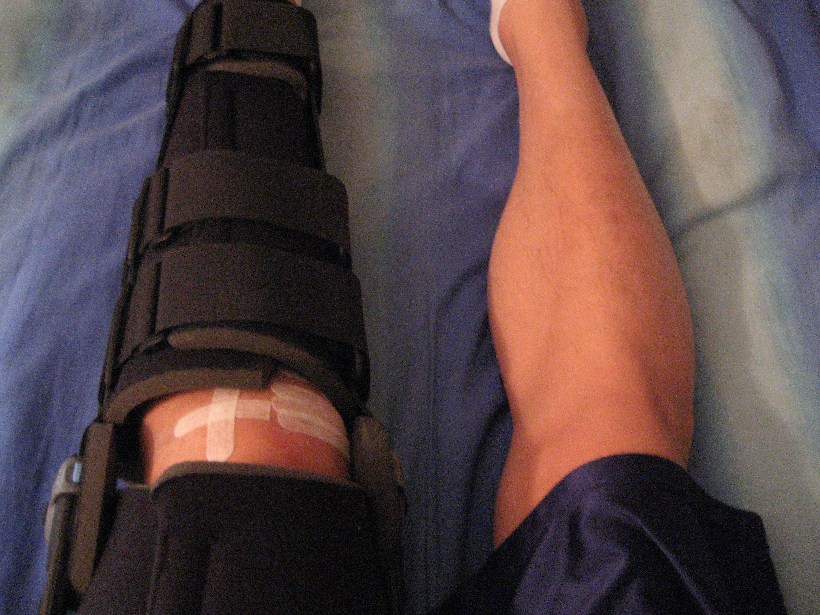 My leg in the intense leg brace